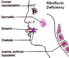 Riboflavin deficiency - Ariboflavinosis | Riboflavin, Medical knowledge, Glossitis