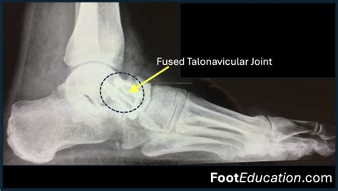 Talonavicular Fusion - FootEducation