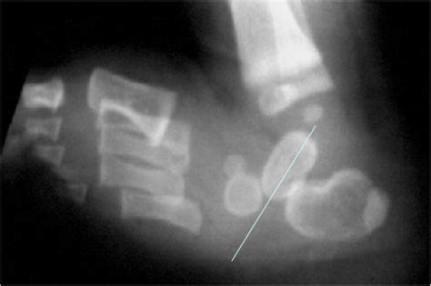 Congenital Vertical Talus - Pediatrics - Orthobullets