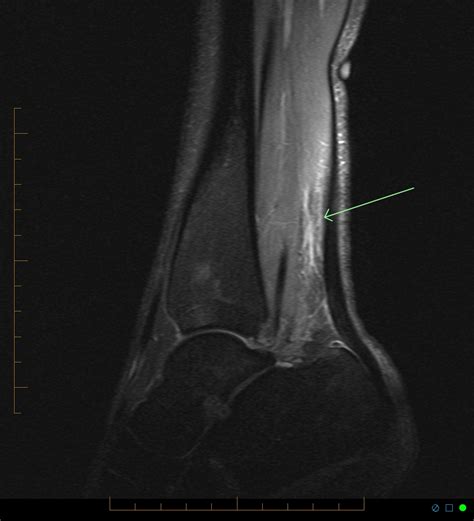 Plantaris tendon rupture | Image | Radiopaedia.org