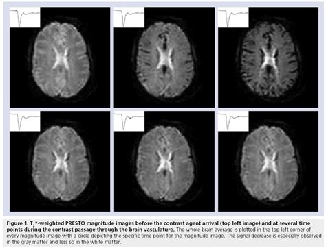 Measurement of cerebral perfusion using MRI