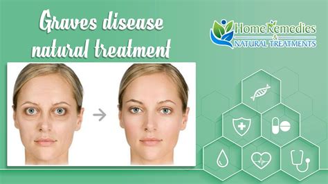 graves disease eyes treatment | graves disease treatment | graves ...