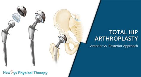 Total Hip Arthroplasty – Anterior vs. Posterior Approach - New Age Physical Therapy