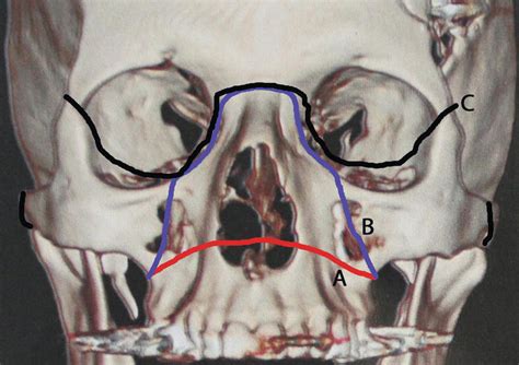 Maxillofacial Fractures: From Diagnosis to Treatment | IntechOpen