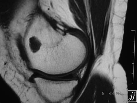 Radioogle | MSK- medial femoral condyle cyst and patellar dislocation (4)