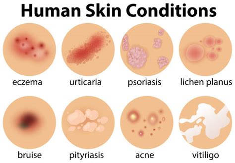 2,500+ Rash Skin Condition Stock Illustrations, Royalty-Free Vector Graphics & Clip Art - iStock