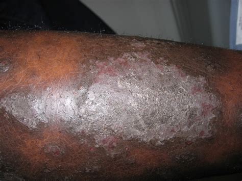 psoriasis-black skin- image source dermatologytimes - Dr. Darams