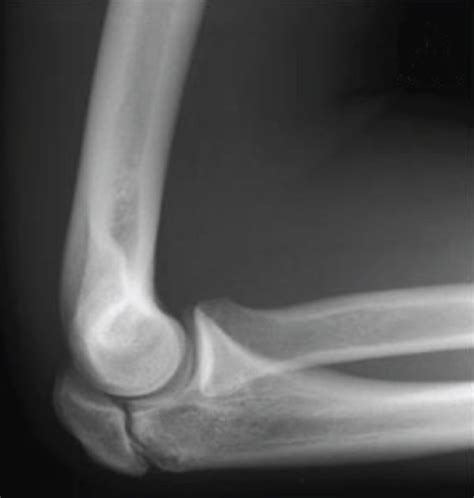 Radiographs of the elbows of a 15-year-old male patient (Patient 1 ...