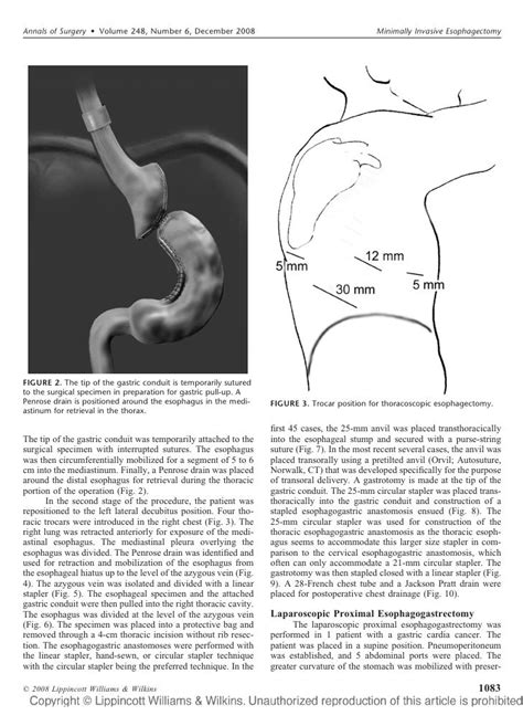 Minimally Invasive Esophagectomy