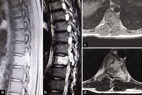 Aneurysmal Bone Cyst Spine