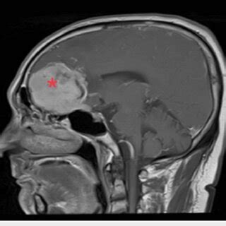 MRI (sagittal view) showing the anterior skull base meningioma (red ...