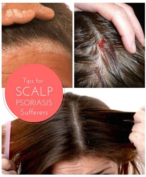 Tips for Finding Effective Relief from the Symptoms of Scalp Psoriasis - Mum's Lounge