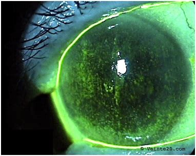 OJO SECO: EPIDEMIOLOGÍA, DIAGNÓSTICO Y TRATAMIENTO - Veinte20