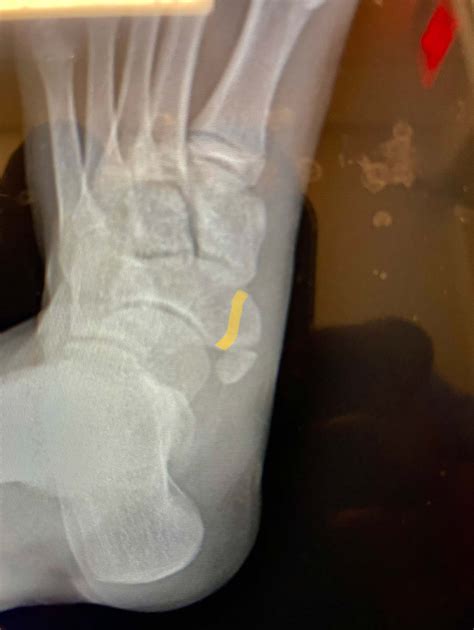 Os Navicular: Accessory Bone Removal - Dominic Carreira, MD - Atlanta