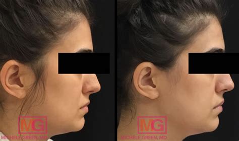 Kybella Swelling & Potential Side Effects, How To Lessen Swelling