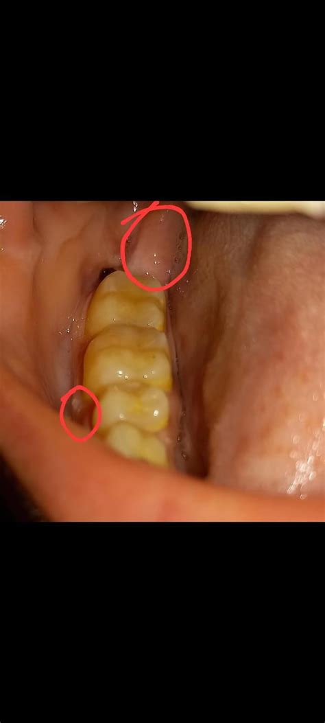 White inflated bumps on gums after wisdom tooth removal. no fever and no swelling. no worsened ...