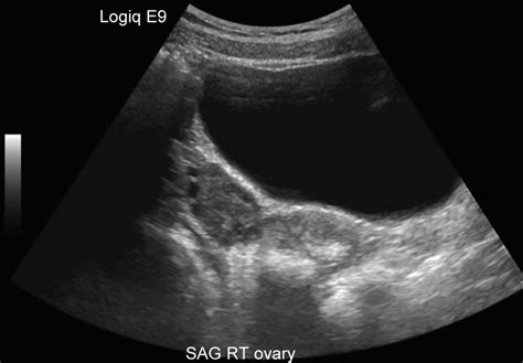 Transabdominal ultrasound of the ovary | Download Scientific Diagram