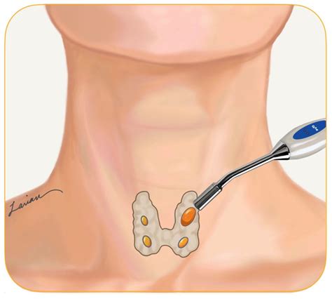 Parathyroid Glands: 4 Gland Parathyroid Assessment | Dr. Babak Larian