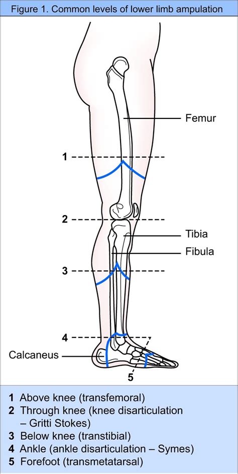 Wound healing complications associated with lower limb amputation