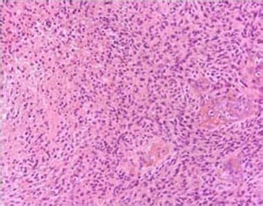 Neurologic Manifestations of Glioblastoma Multiforme Workup: Laboratory ...