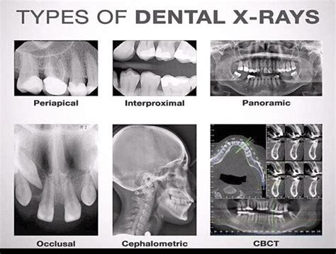 Types of Dental X-Rays | Dental, Dental hygiene school, Dental assistant study