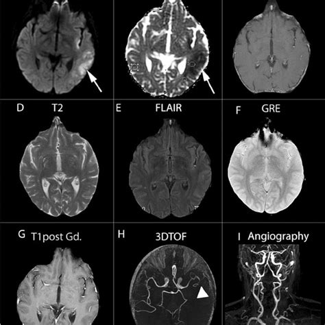 MRI findings in acute and subacute strokes. (A) During acute stroke,... | Download Scientific ...