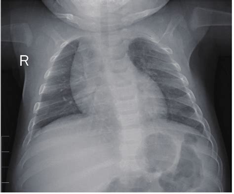 The pneumatocele increased in size. Figure 6. Normal chest X-ray after... | Download Scientific ...