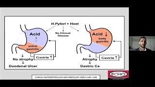 Intestinal Metaplasia: Symptoms, Causes, Treatment - An Tâm