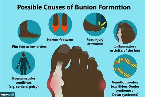 Bunions: Symptoms, Causes, Diagnosis, and Treatment