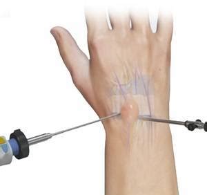 Arthroscopic Ganglion Excision, NSW | Wrist Arthroscopic Surgery, NSW