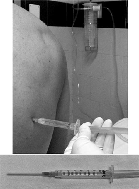 Thoracentesis Needle Size