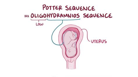 Potter sequence: Video, Anatomy, Definition & Function | Osmosis