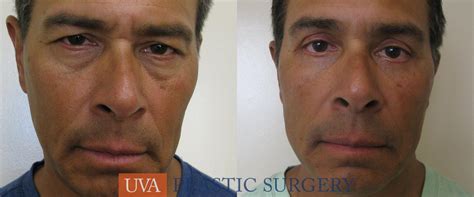 Eyelid Surgery for Richmond, Charlottesville & Roanoke, VA - UVA ...