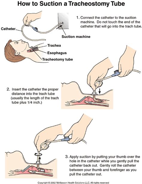 Premier Care Pediatrics Patient Information: How to Suction a ...