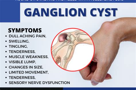 Ganglion cyst wrist treatment - Dr NasirPhysiotherapy and Rehabilation