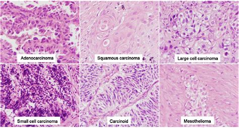 Histological profile of carcinomas of the lung and pleura. Stain:... | Download Scientific Diagram