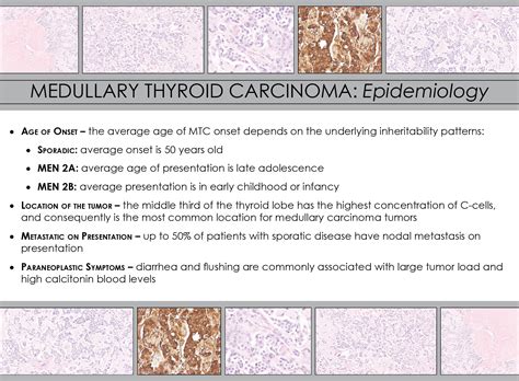 Medullary Thyroid Carcinoma Pathology | Iowa Head and Neck Protocols