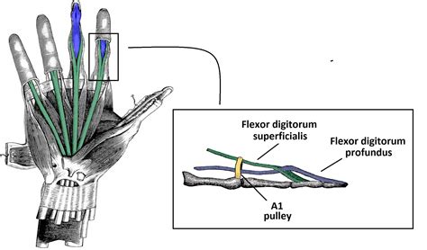 The Flexor Pulley System of the Hand - Annular - Cruciate - Oblique ...