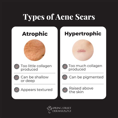 Combating Acne Scars: Effective Medical Solutions - Spring Street ...