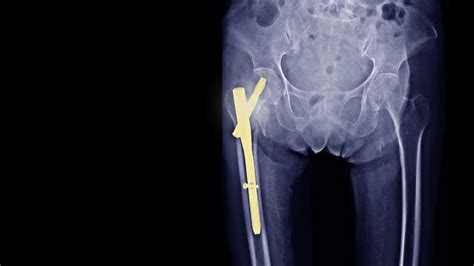 Does the treatment of hip fractures with intramedullary nails kill ...