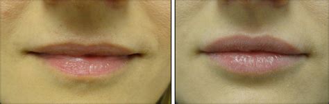 Collagen Injection Lips Before And After Photos - Infoupdate.org