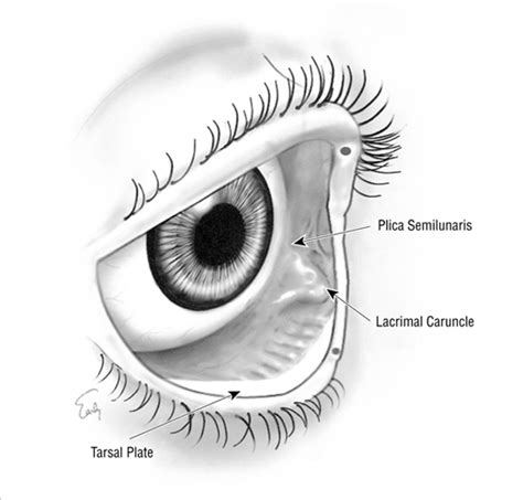 The Precaruncular Approach to the Medial Orbit | JAMA Facial Plastic Surgery | JAMA Network