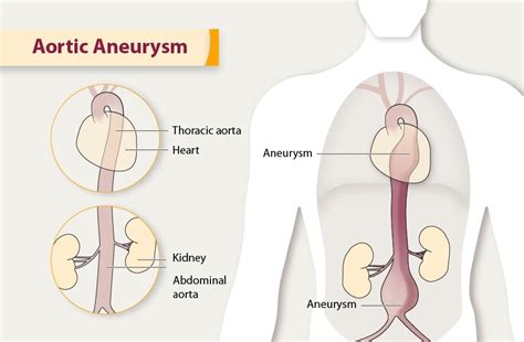 Thoracic Aortic Aneurysm Classification