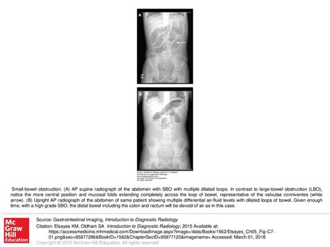 Small-bowel obstruction - ppt download