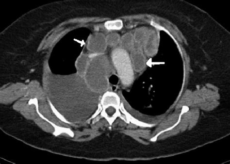 Mediastinal Lymph Nodes Ct Scan