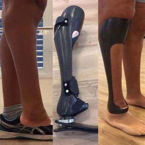 Neoprene Leg Symes Prosthesis, Size: 1-2 Feet, Right Side, Rs 10000 /piece | ID: 21941498648