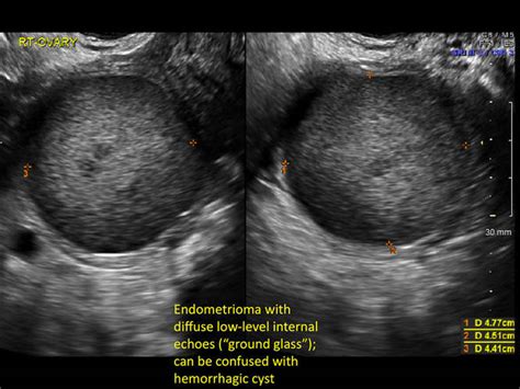 Hemorrhagic ovarian cysts: One entity with many appearances | MDedge ObGyn