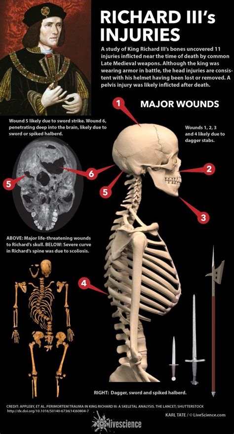 The Fatal Wounds of King Richard III (Infographic) | Live Science