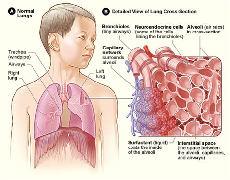 Interstitial Lung Diseases - Childhood Interstitial Lung Disease ...