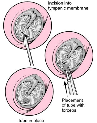 Ear Infections and Effective Surgeries to Get Rid of Them | SiOWfa15 ...